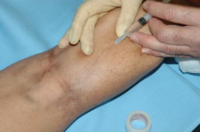 Eskleroterapia