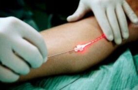 Laser Barizeen tratamendua hanketan
