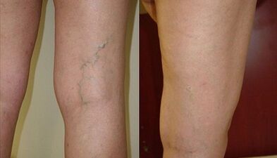 barizeetarako mikroflebectomia