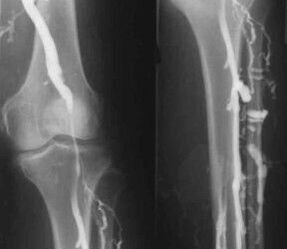 Diagnostiko aukerak muturretako barizeak