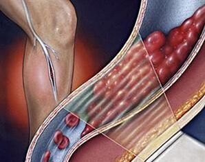 beheko muturretako zain sakonetako barizeak